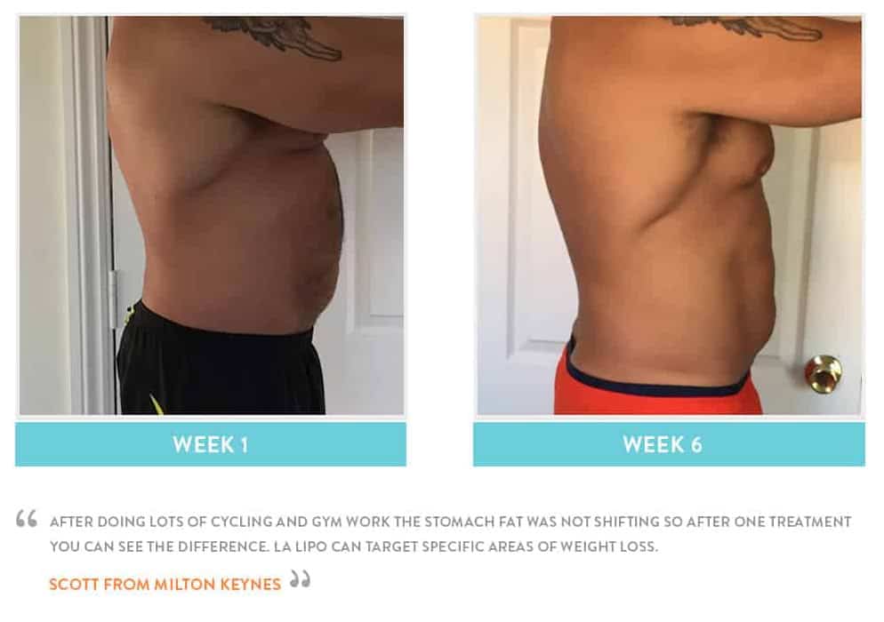 Before & After Stomach Fat Dunchurch