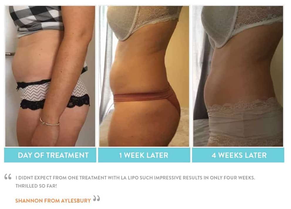 before, Cryolipolysis Dunchurch