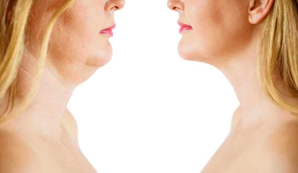 Double Chin treatment Dunchurch before and after results