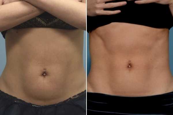 body sculpting FAQs Dunchurch