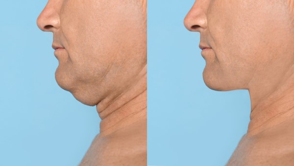 Which Non-Surgical Treatments Work Best for Jowls and Loose Skin Dunchurch?