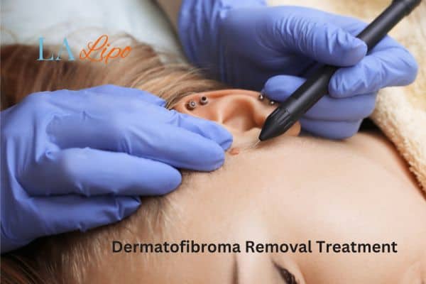 Dermatofibroma Removal Treatment Dunchurch