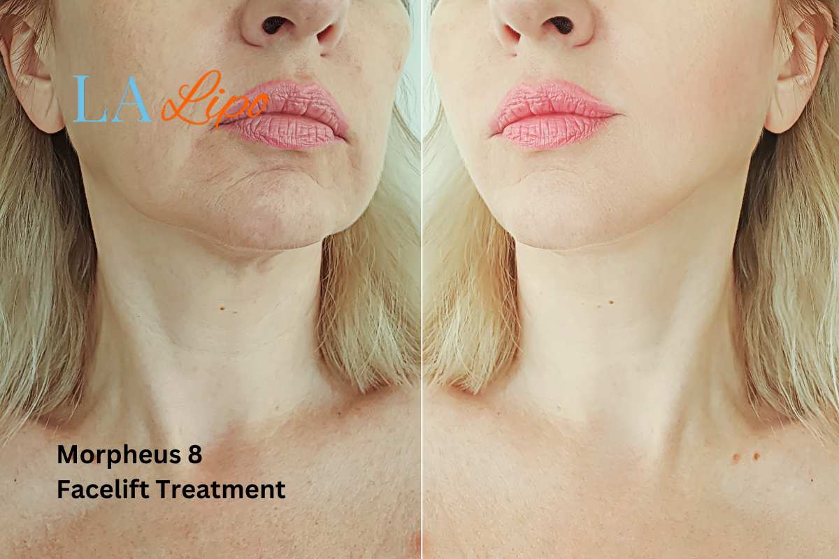 Turn back time with Morpheus8 Treatment Dunchurch