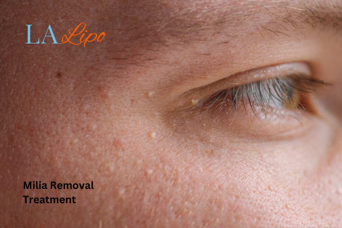 Cryopen Milia Removal: Is It the Easiest and Safest Option Dunchurch?