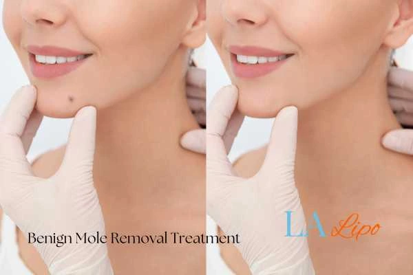 woman's before and after mole removal Dunchurch results