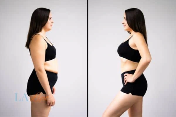 image of woman before and after results of LA-EMS Body Sculpting Dunchurch to help treat Diastasis recti