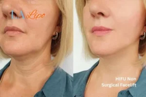 hi-fu for wrinkles Dunchurch before and after results