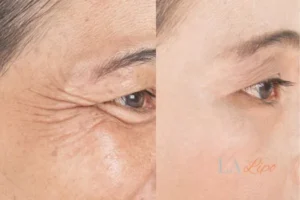 Before and after results of woman - HI-fu wrinkles reduction treatment Dunchurch