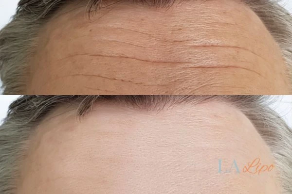 results of HIFU Dunchurch on mans forehead to help reduce lines and wrinkles