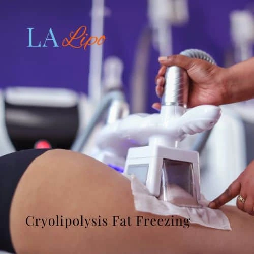 fat freezing - Cryolipolysis Dunchurch