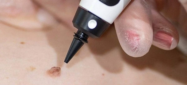 skin tag removal using cryopen Dunchurch