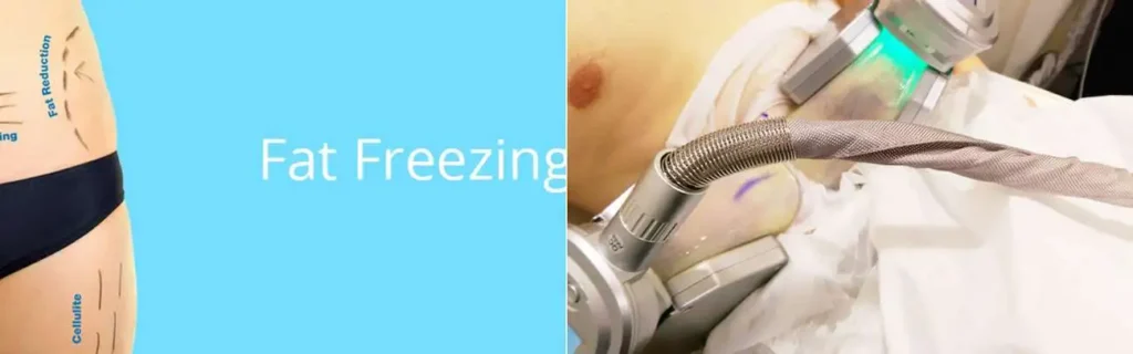 multi areas of a persons body having coolsculpting Dunchurch treatment
