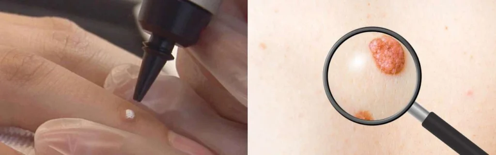 Person getting moles removed with cryopen Dunchurch