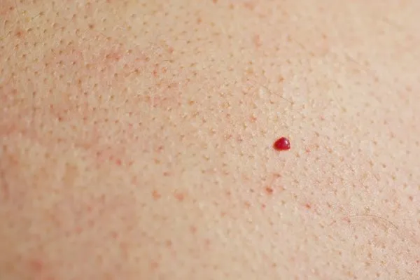 close up of a cherry angioma Dunchurch