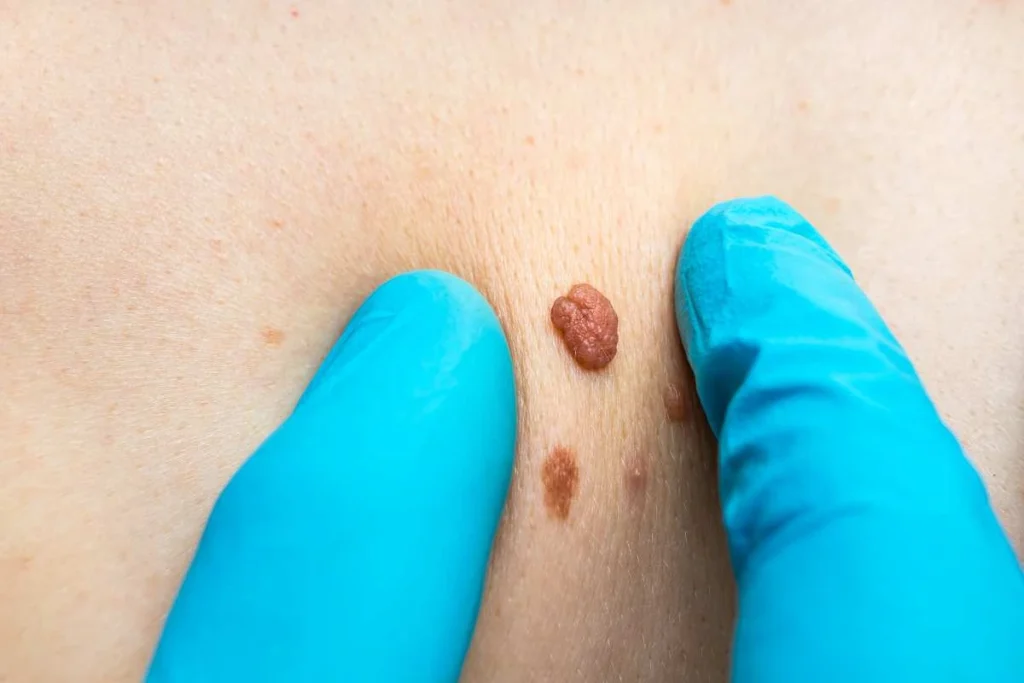 Consultant examining a skin tag Dunchurch