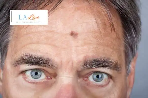 Solar Lentigo Removal Dunchurch image of man with mark on his forehead