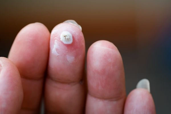 wart on person finger - cryotherapy to treat from LA LIPO Dunchurch