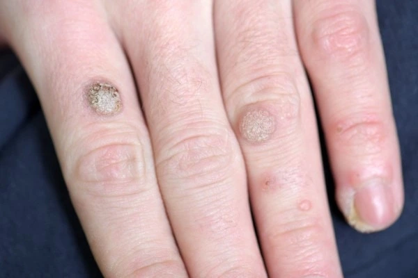 photo of warts on person hand - see wart removal Dunchurch from LA LIPO