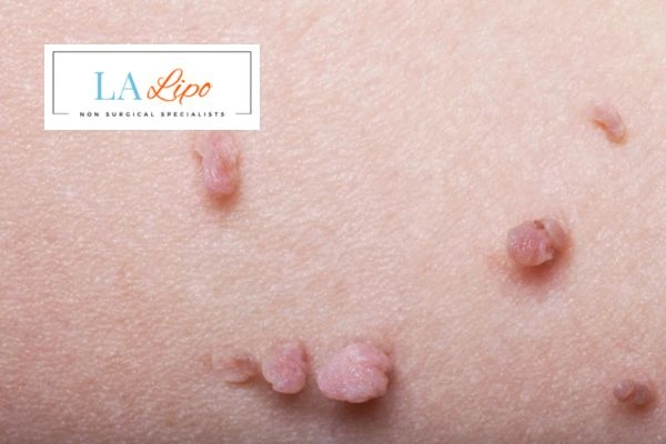 Does cryopen skin tag removal Dunchurch hurt? Find out now call our team today!