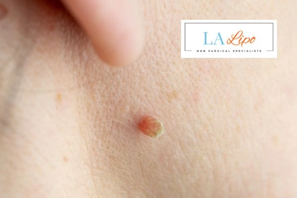 Book skin tag removal Dunchurch today speak to our team now!