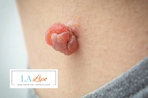 Interested in skin tag removal Dunchurch? Concerned about the pain? Find out more today!