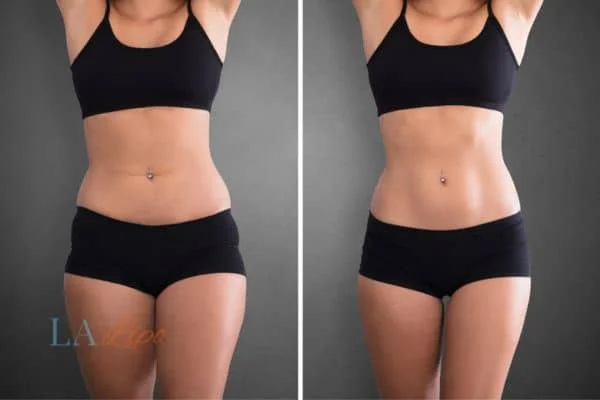 before and after results of non-surgical treatment to help a woman's body image and mental health Dunchurch