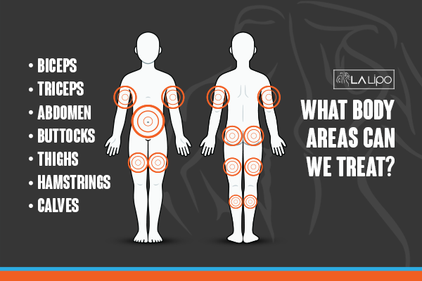 Diagram to show areas you can have LA-EMS Body Sculpting Treatment Dunchurch