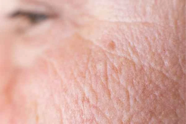 close up picture of a woman's face showing an age spot Dunchurch