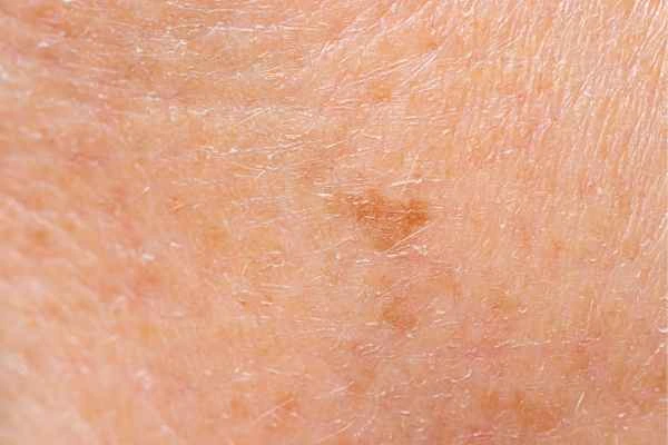 close up picture of age spots Dunchurch