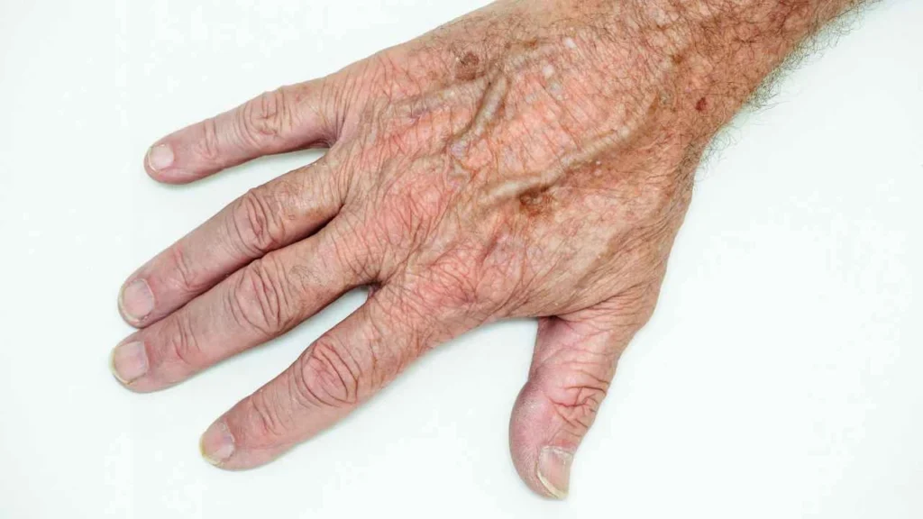 Male hand showing age spot Dunchurch