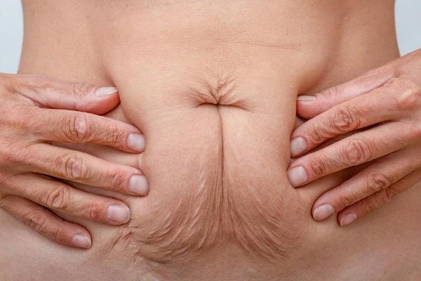 Image of a woman's stomach with loose skin - example of skin tightening Dunchurch options