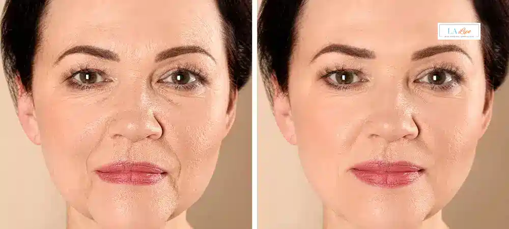 How Long Does It Take to See Results and How Long Do They Last Dunchurch?