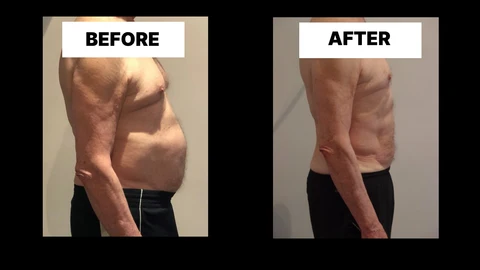 What Symptoms Can Diastasis Recti Cause in Men? Weak Core, Back Pain and Poor Posture Dunchurch